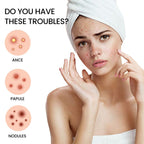 Acne Patch, Repair Facial Acne Invisible Concealer Hydrocolloid Patch