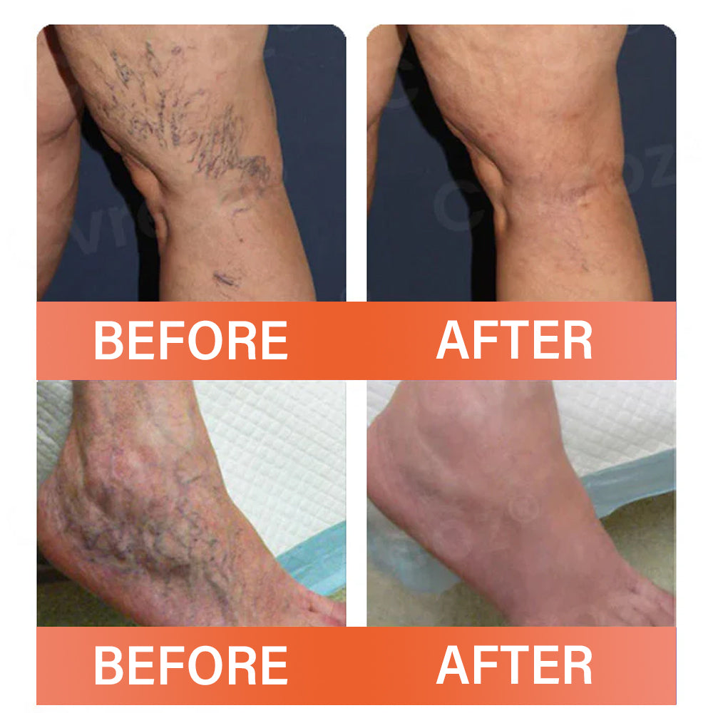 VeinEase Microneedle Therapy Patch