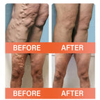 VeinEase Microneedle Therapy Patch