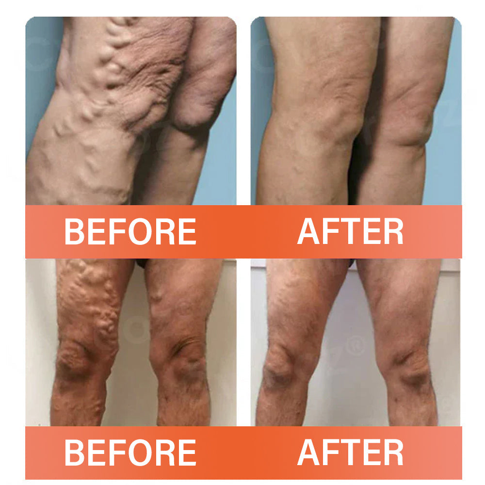 VeinEase Microneedle Therapy Patch