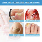 Toenail Fungus Treatment, Repair The Brotherhood Of Nails Rotten Jiasheng Mail This Soft Armour A Detailer