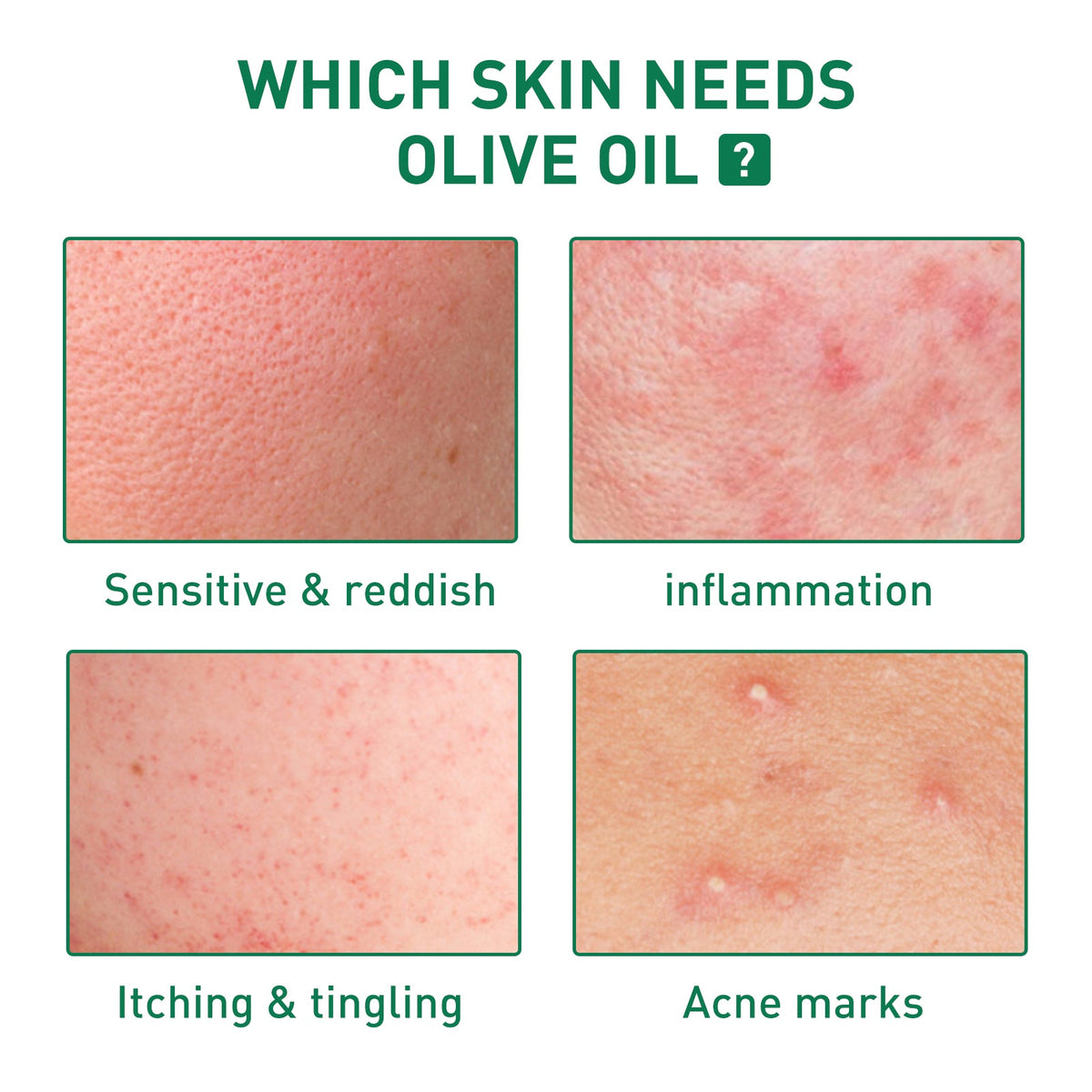 Tea Tree Oil Acne Serum, Remove Acne, Clear Acne, Repair Skin, Lighten Acne Printing Face Essence