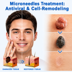 ✨2-in-1 Microneedle & Hydrocolloid Patch🍀| Removes Raised Moles, Acne, Flat Warts & Skin Tags | Helps Improve Wrinkles, Scars & Blemishes | Invisible Patches for Face & Body