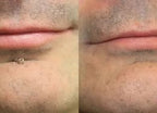 ✨2-in-1 Microneedle & Hydrocolloid Patch🍀| Removes Raised Moles, Acne, Flat Warts & Skin Tags | Helps Improve Wrinkles, Scars & Blemishes | Invisible Patches for Face & Body