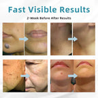 ENN-VHH QIAWI™ All-in-One CO₂ Laser Eraser Pen by Aurenza Shop, showing the sleek handheld device for skin flaw removal.