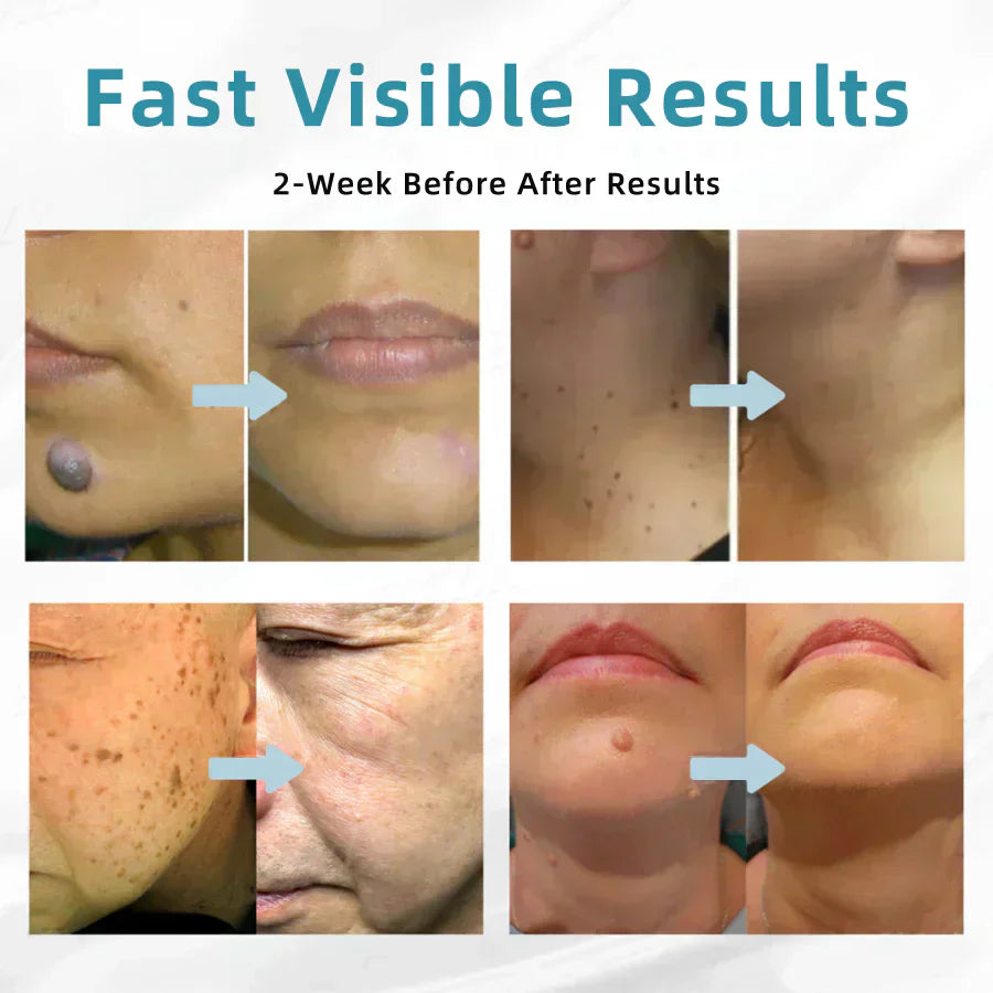 ENN-VHH QIAWI™ All-in-One CO₂ Laser Eraser Pen by Aurenza Shop, showing the sleek handheld device for skin flaw removal.