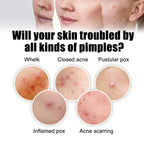 Acne Removal Protection Defense Patch, Color Profile-shaped Portable Invisible Cover Acne Patch