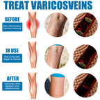 Leg Care Spray Gently Relieve Leg Discomfort, Blue Veins And Bumps Repair Daily Care