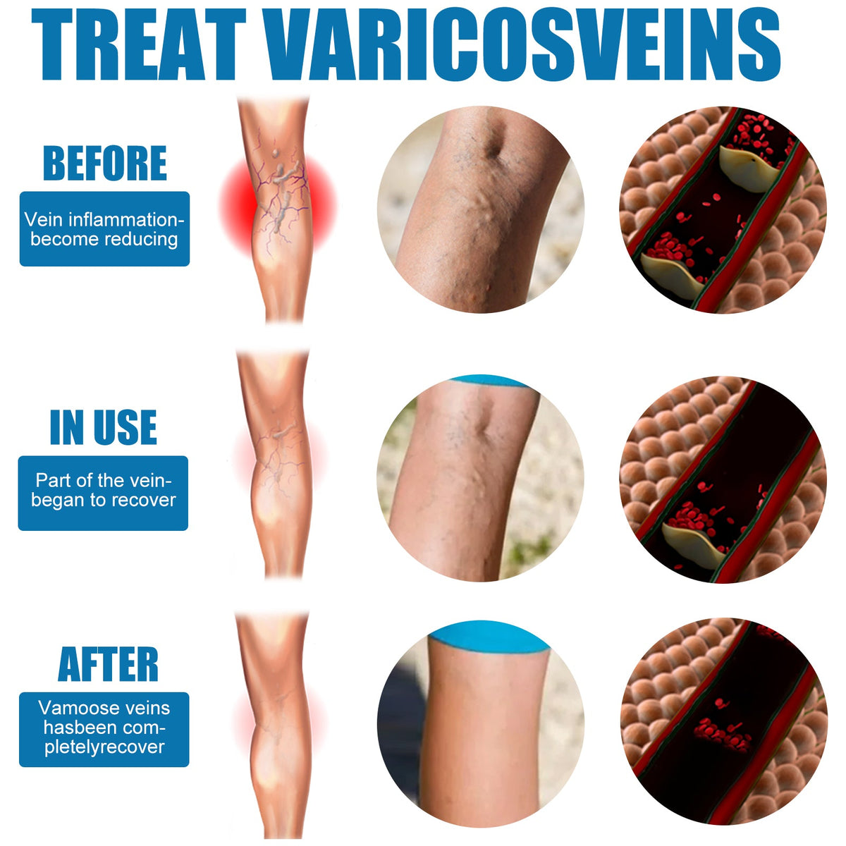 Leg Care Spray Gently Relieve Leg Discomfort, Blue Veins And Bumps Repair Daily Care