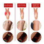 Intravenous Massage Spray For Varicose Veins Relief And Earthworm Leg Blood Vessel Bulge Pain Spray