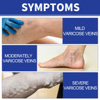 Vein Comfort Spray, Relief Leg Muscle Soreness And Swelling Earthworm Leg Vein Treatment Spray
