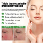 Herbal Eczema Ointment, Relieve Hand And Foot Moss Skin Redness Itchy Skin Repair Ointment