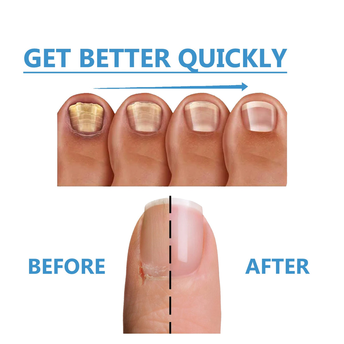 Toenail Fungus Treatment, Repair The Brotherhood Of Nails Rotten Jiasheng Mail This Soft Armour A Detailer
