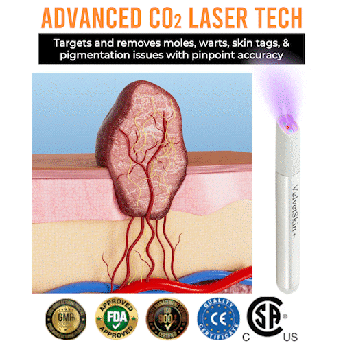 Aurenza QIAWI™ All-in-One CO₂ Laser Eraser Pen in action, demonstrating mole and wart removal on skin with GIF animation