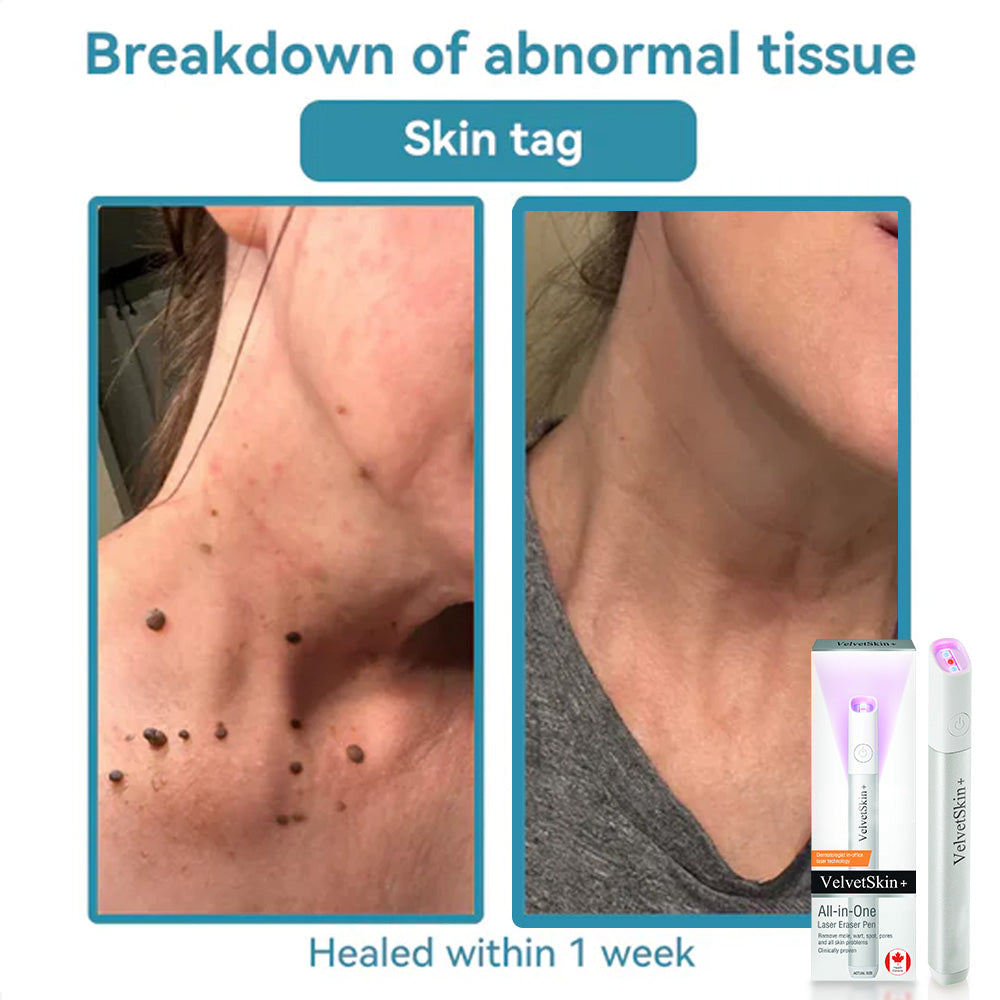 Aurenza QIAWI™ All-in-One CO₂ Laser Eraser Pen for removing moles, warts, skin flaws, and pigmentation in a compact handheld device.