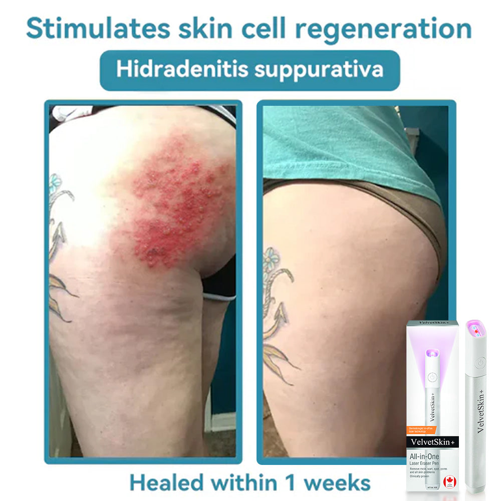ENN-VHH QIAWI™ All-in-One CO₂ Laser Eraser Pen for removing moles, warts, skin flaws, and pigmentation, held in hand.