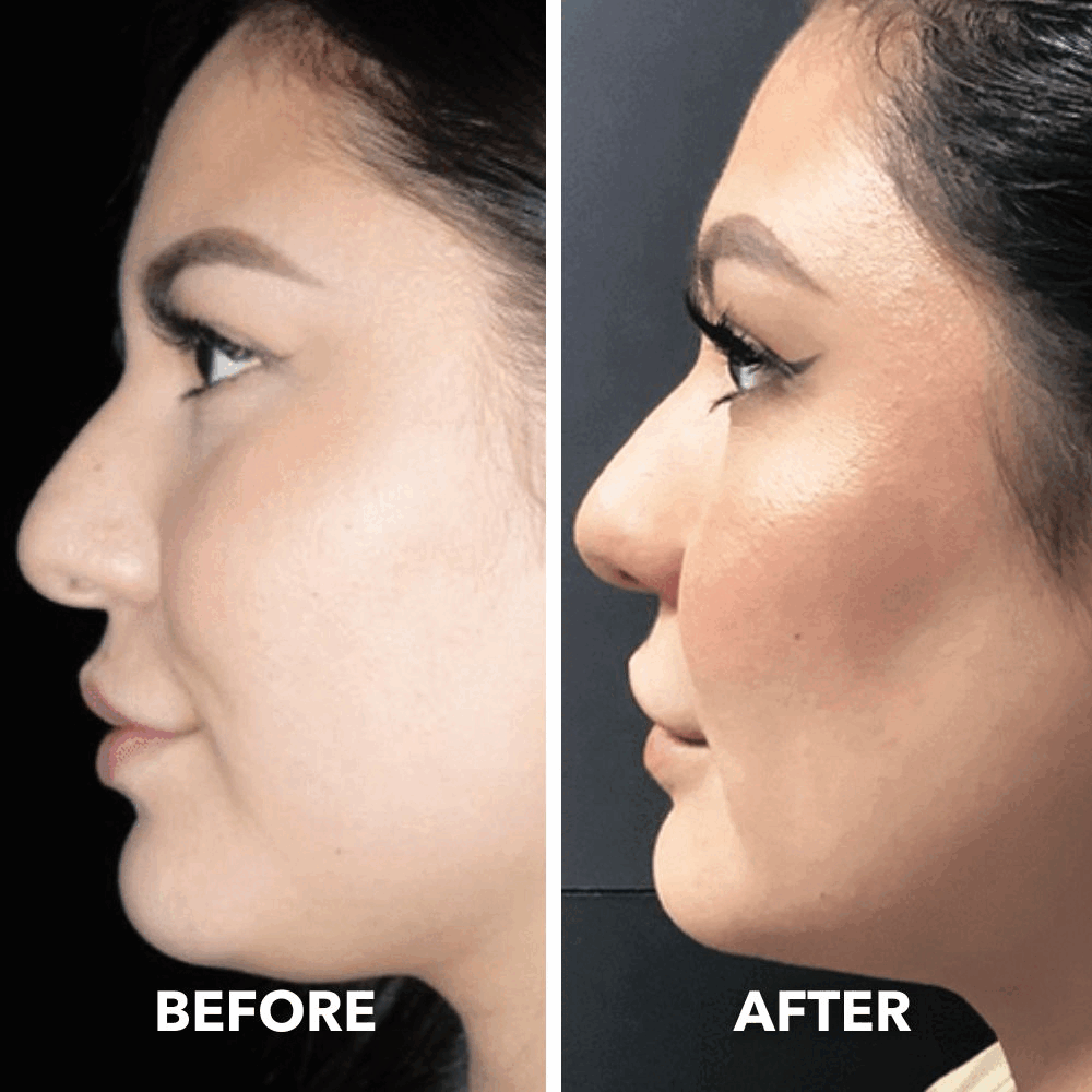 Arenzza smart face sculpting device with 8 modes for double chin reduction and jawline definition, shown in use.