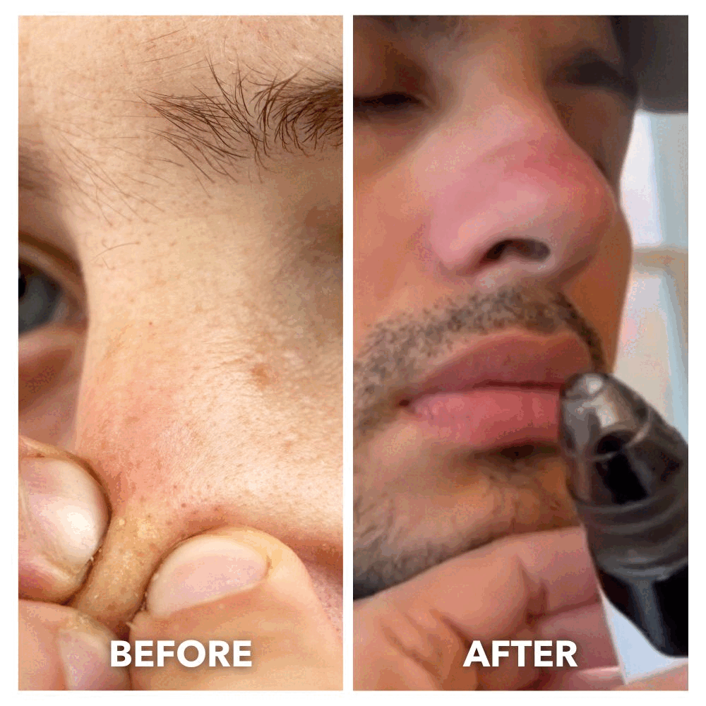 Aurenza Shop blackhead remover pore vacuum cleaner with a sleek black design, handheld device for facial pore cleansing.
