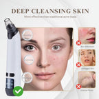 Aurenza Blackhead Remover Pore Vacuum Cleaner showing the handheld device with a suction head for skin pore cleaning.