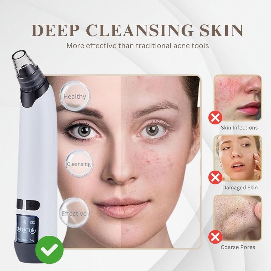 Aurenza Blackhead Remover Pore Vacuum Cleaner showing the handheld device with a suction head for skin pore cleaning.