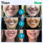 Aurenza UNPREE™ Gum Therapy Gel in a small tube, designed for oral gum health, displayed on a white background.