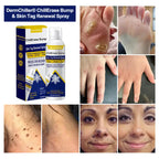 Aurenza DermChiller ChillErase Bump & Skin Tag Renewal Spray bottle, ready for use on skin imperfections and tags.