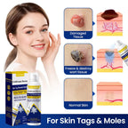 Aurenza DermChiller ChillErase Bump and Skin Tag Renewal Spray bottle with label, designed for skin bump and tag treatment.
