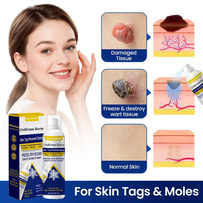 Aurenza DermChiller ChillErase Bump and Skin Tag Renewal Spray bottle with label, designed for skin bump and tag treatment.