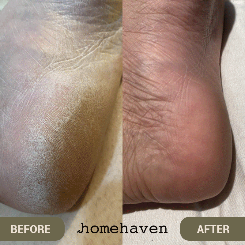 Aurenza SpaSculpt Pro Pedicure & Callus Remover device for smooth feet and effective callus removal in a close-up shot.