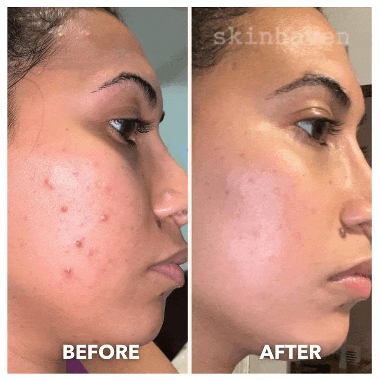 Aurenza Shop Face Mask Light Therapy Gen.2 in gold, with sleek design and adjustable straps for skin rejuvenation treatment.