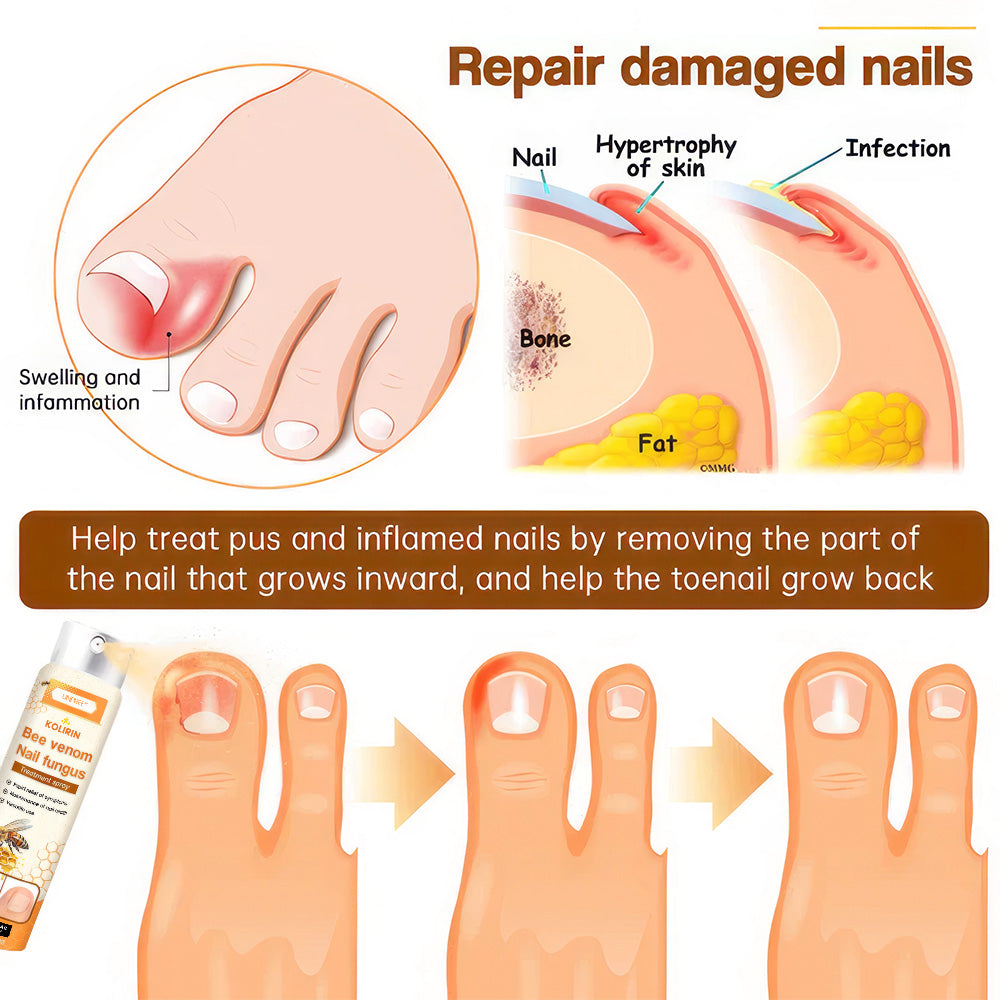 Aurenza Shop Unpree Kolirin Bee Venom Nail Fungus Spray bottle for fixing nail problems, displayed on a neutral background.