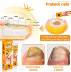 Aurenza Shop UNPREE™ Kolirin Bee Venom Nail Fungus Treatment Cream jar with label and product packaging visible.