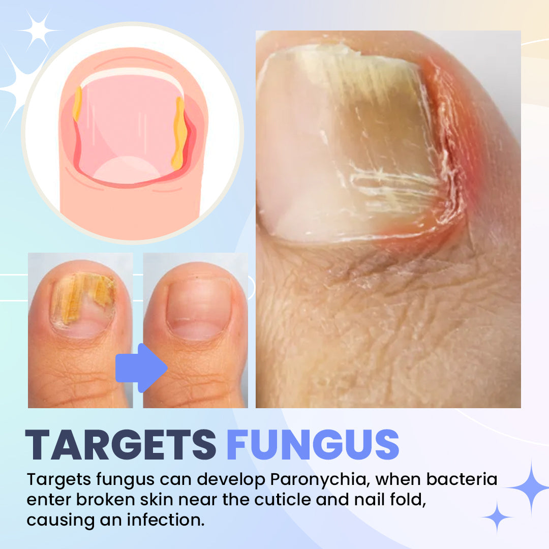 Aurenza Shop SUPTRUCK™ Nail Fungus LED Light Therapy Device for treating nail fungus, shown in a sleek compact design.