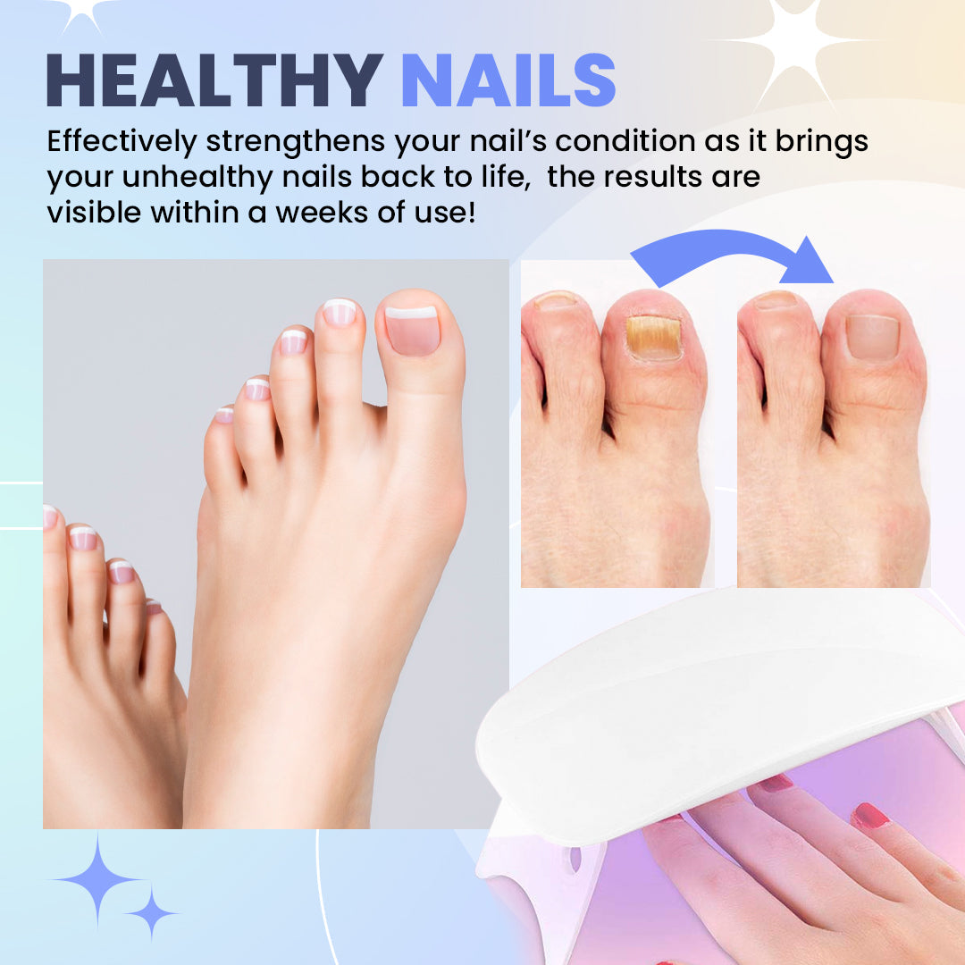 Aurenza Shop SUPTRUCK™ Nail Fungus LED Light Therapy Device for effective treatment of toenail and fingernail fungus.