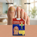 Aurenza Shop Repair Nail and Stop Yellow Fungus Fungus Premium Patch applied to a toenail, promoting fungal infection healing overnight.