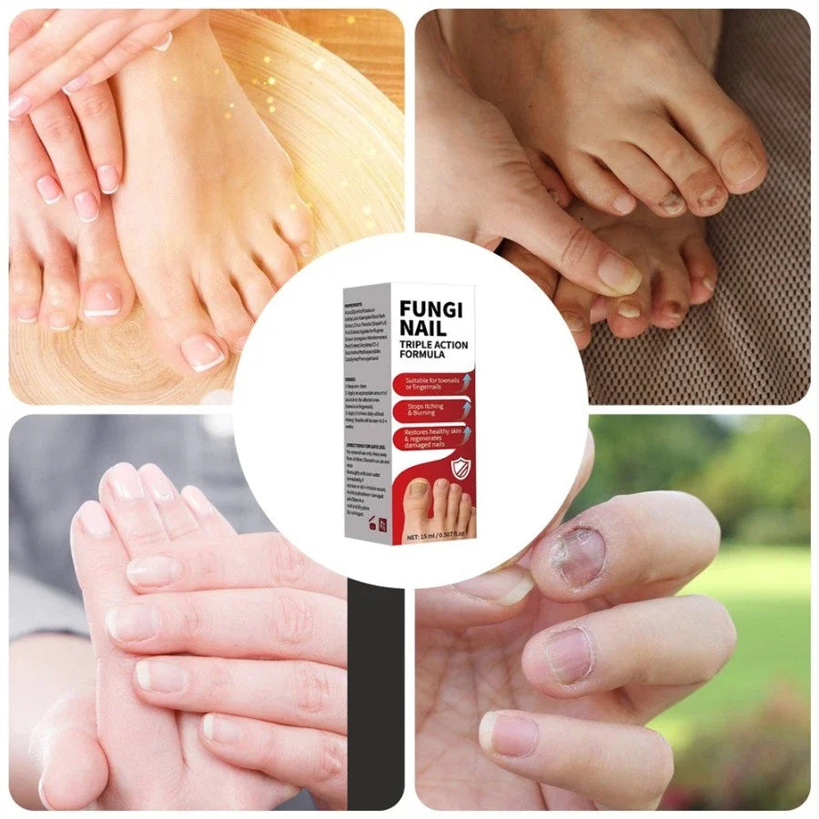 Fungi Nail Anti-Fungal Liquid Herbal Extracts Toenail Fungus Treatment Safe Us